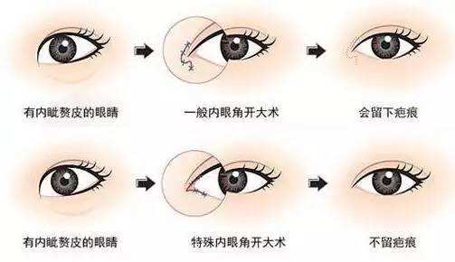 杭州双眼皮修复知名专家排行榜 杭州最好的双眼皮修复专家排名 杭州最好的双眼皮修复专家有哪些?