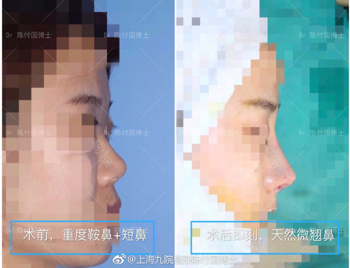 陈付国隆鼻案例