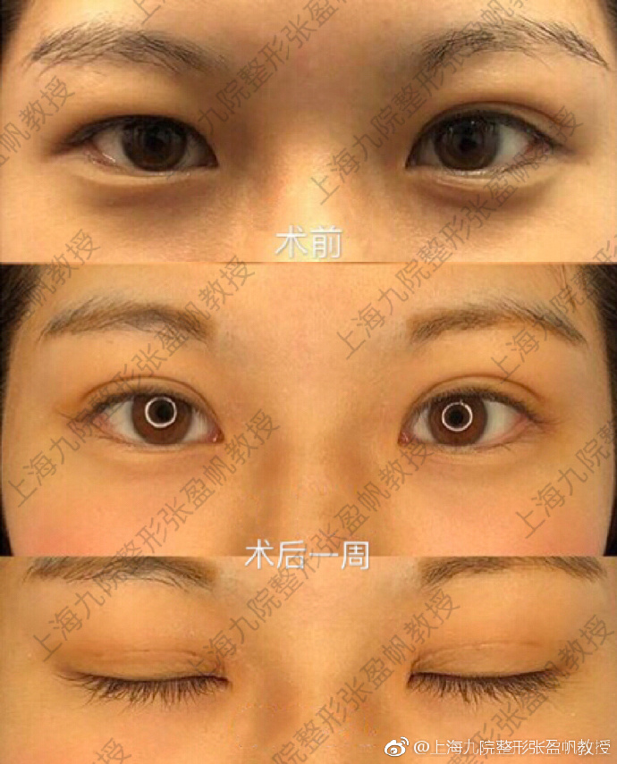 张盈帆割双眼皮案例