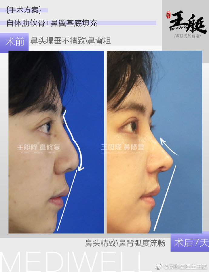 王艇鼻修复案例