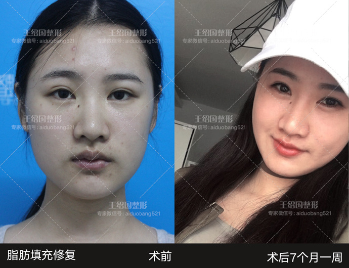 王绍国脂肪修复案例
