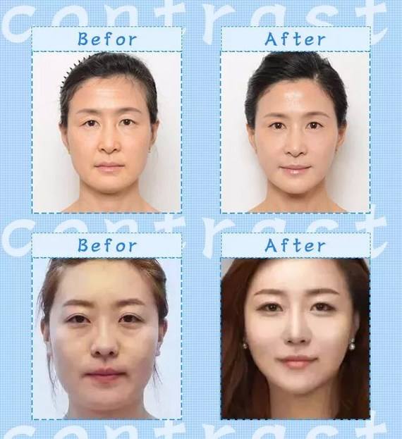 全脸提升什么效果最好?全脸提升多少钱一次?
