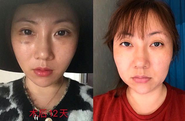 上海赵寅局做拉皮技术怎么样?